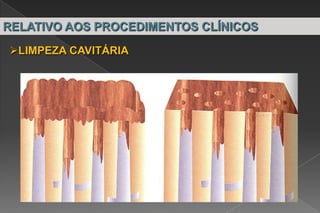 RELATIVO AOS PROCEDIMENTOS CLÍNICOS
LIMPEZA CAVITÁRIA
 