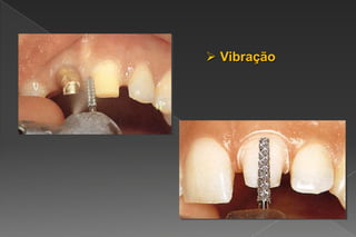  Vibração
 