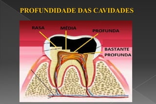 PROFUNDIDADE DAS CAVIDADES
 