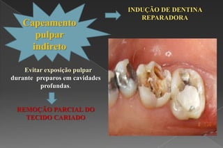 Capeamento
pulpar
indireto
Evitar exposição pulpar
durante preparos em cavidades
profundas.
REMOÇÃO PARCIAL DO
TECIDO CARIADO
INDUÇÃO DE DENTINA
REPARADORA
 