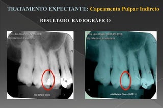 TRATAMENTO EXPECTANTE: Capeamento Pulpar Indireto
RESULTADO RADIOGRÁFICO
 