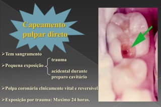 Tem sangramento
trauma
Pequena exposição
acidental durante
preparo cavitário
Polpa coronária clnicamente vital e reversível
Exposição por trauma: Maximo 24 horas.
Capeamento
pulpar direto
 