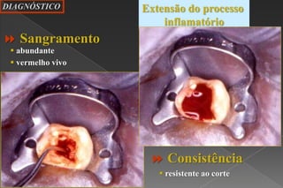  vermelho vivo
 resistente ao corte
 abundante
Extensão do processo
inflamatório
DIAGNÓSTICO
 Sangramento
 Consistência
 