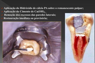 Aplicação do Hidróxido de cálcio PA sobre o remanescente pulpar;
Aplicação do Cimento de Ca(OH)2 ;
 Remoção dos excessos das paredes laterais;
Restauração imediata ou provisória;
 