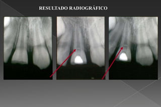 RESULTADO RADIOGRÁFICO
 
