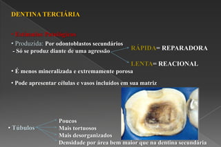 DENTINA TERCIÁRIA
• Estímulos Patológicos
• Produzida: Por odontoblastos secundários
- Só se produz diante de uma agressão RÁPIDA= REPARADORA
LENTA= REACIONAL
• É menos mineralizada e extremamente porosa
• Pode apresentar células e vasos incluídos em sua matriz
• Túbulos
Poucos
Mais tortuosos
Mais desorganizados
Densidade por área bem maior que na dentina secundária
 