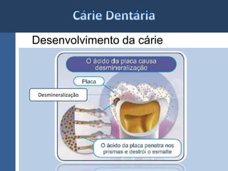 Desenvolvimento da cárie 
Desmineralização 
 