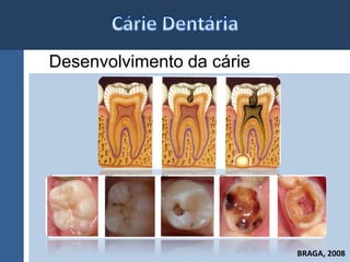 Desenvolvimento da cárie 
BRAGA, 2008 
 