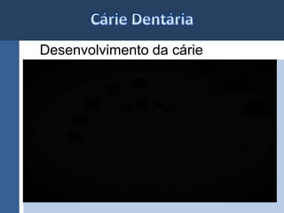 Desenvolvimento da cárie 
 