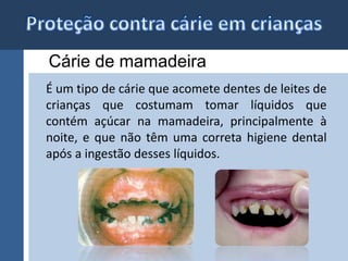 Cárie de mamadeira 
É um tipo de cárie que acomete dentes de leites de 
crianças que costumam tomar líquidos que 
contém açúcar na mamadeira, principalmente à 
noite, e que não têm uma correta higiene dental 
após a ingestão desses líquidos. 
 