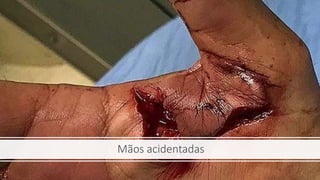 Mãos acidentadas
 