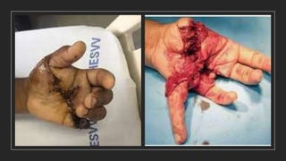 Proteção das mãos, cuidados com os dedos