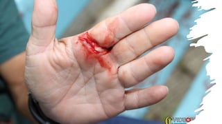 Proteção das mãos, cuidados com os dedos