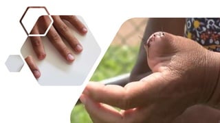 Proteção das mãos, cuidados com os dedos