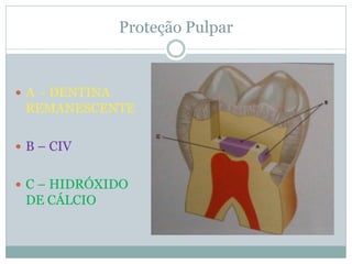 Proteção Pulpar


 A - DENTINA
 REMANESCENTE

 B – CIV


 C – HIDRÓXIDO
 DE CÁLCIO
 