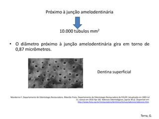 Próximo à junção amelodentinária


                                                    10.000 túbulos mm2

• O diâmetro próximo à junção amelodentinária gira em torno de
  0,87 micrômetros.



                                                                                            Dentina superficial




Mandarino F. Departamento de Odontologia Restauradora. Ribeirão Preto: Departamento de Odontologia Restauradora da FOUSP; [atualizada em 2003 Jul
                                                                    11; acesso em 2010 Apr 26]. Adesivos Odontológicos; [aprox 30 p]. Disponível em:
                                                                       http://www.forp.usp.br/restauradora/dentistica/temas/adesivos/adesivos.htm.




                                                                                                                                          Terra, G.
 