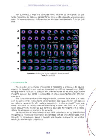 103
PROTEÇÃO RADIOLÓGICA NO DIAGNÓSTICO E TERAPIA
Por outro lado, a Figura 16 demonstra uma imagem de cintilografia de per-
fusão miocárdica de paciente apresentando IAM, sendo possível a visualização de
áreas de hipocaptação, as quais demonstram tecidos onde já não há fluxo sanguí-
neo.
Figura 16 − Cintilografia de perfusão miocárdica com IAM
Fonte: Rocha, 2018.
• Instrumentação
Nos exames de perfusão miocárdica é necessário a utilização de equipa-
mentos de diagnóstico que realizam imagens tomográficas, denominados SPECT.
O equipamento rotaciona o detector em torno do tórax do paciente, registrando
imagens planares que serão reconstruídas em imagens computacionais em 3 di-
mensões.
São comumente encontrados equipamentos com dois detectores que reali-
zam a aquisição mais rapidamente se comparados aos equipamentos com apenas
um detector. Atualmente, são também encontrados equipamentos CZT, que pos-
suem detectores de telureto de cádmio e zinco (Cadmium Zinc Telluride − CZT), os
quais possuem uma tecnologia que permite a aquisição de imagens sem a neces-
sidade de rotacionarem em torno do paciente.
Também são utilizados monitores cardíacos associados ao equipamento de
imagem para realização da aquisição sincronizada com os sinais fisiológicos, iden-
tificando os períodos de sístole e diástole, resultando em imagens com melhor
resolução e informação diagnóstica.
 