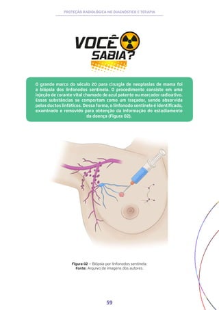 59
PROTEÇÃO RADIOLÓGICA NO DIAGNÓSTICO E TERAPIA
O grande marco do século 20 para cirurgia de neoplasias de mama foi
a biópsia dos linfonodos sentinela. O procedimento consiste em uma
injeção de corante vital chamado de azul patente ou marcador radioativo.
Essas substâncias se comportam como um traçador, sendo absorvida
pelos ductos linfáticos. Dessa forma, o linfonodo sentinela é identificado,
examinado e removido para obtenção da informação do estadiamento
da doença (Figura 02).
Figura 02 − Biópsia por linfonodos sentinela.
Fonte: Arquivo de imagens dos autores.
 