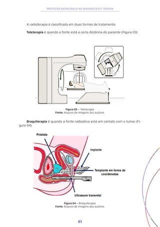 61
PROTEÇÃO RADIOLÓGICA NO DIAGNÓSTICO E TERAPIA
A radioterapia é classificada em duas formas de tratamento:
Teleterapia é quando a fonte está a certa distância do paciente (Figura 03).
Figura 03 – Teleterapia.
Fonte: Arquivo de imagens dos autores.
Figura 04 – Braquiterapia.
Fonte: Arquivo de imagens dos autores.
Braquiterapia é quando a fonte radioativa está em contato com o tumor (Fi-
gura 04).
 