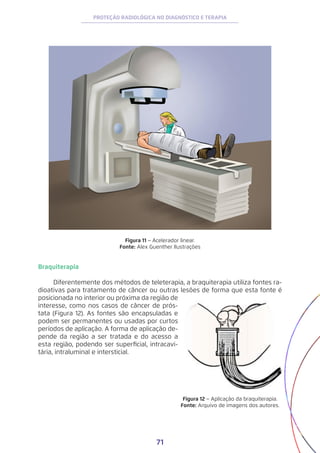 71
PROTEÇÃO RADIOLÓGICA NO DIAGNÓSTICO E TERAPIA
Figura 11 − Acelerador linear.
Fonte: Alex Guenther Ilustrações
Braquiterapia
Diferentemente dos métodos de teleterapia, a braquiterapia utiliza fontes ra-
dioativas para tratamento de câncer ou outras lesões de forma que esta fonte é
posicionada no interior ou próxima da região de
interesse, como nos casos de câncer de prós-
tata (Figura 12). As fontes são encapsuladas e
podem ser permanentes ou usadas por curtos
períodos de aplicação. A forma de aplicação de-
pende da região a ser tratada e do acesso a
esta região, podendo ser superficial, intracavi-
tária, intraluminal e intersticial.
Figura 12 − Aplicação da braquiterapia.
Fonte: Arquivo de imagens dos autores.
 