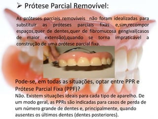  Prótese Parcial Removível:
As próteses parciais removíveis não foram idealizadas para
substituir as próteses parciais fixas e,sim,recompor
espaços,quer de dentes,quer de fibromucosa gengival(casos
de maior extensão),quando se torna impraticável a
construção de uma prótese parcial fixa.

Pode-se, em todas as situações, optar entre PPR e
Prótese Parcial Fixa (PPF)?
Não. Existem situações ideais para cada tipo de aparelho. De
um modo geral, as PPRs são indicadas para casos de perda de
um número grande de dentes e, principalmente, quando
ausentes os últimos dentes (dentes posteriores).

 