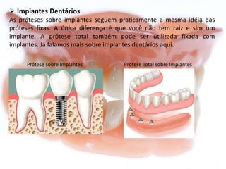  Implantes Dentários
As próteses sobre implantes seguem praticamente a mesma idéia das
próteses fixas. A única diferença é que você não tem raiz e sim um
implante. A prótese total também pode ser utilizada fixada com
implantes. Já falamos mais sobre implantes dentários aqui.
Prótese sobre Implantes

Prótese Total sobre Implantes

 
