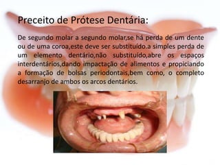 Preceito de Prótese Dentária:
De segundo molar a segundo molar,se há perda de um dente
ou de uma coroa,este deve ser substituído.a simples perda de
um elemento dentário,não substituído,abre os espaços
interdentários,dando impactação de alimentos e propiciando
a formação de bolsas periodontais,bem como, o completo
desarranjo de ambos os arcos dentários.

 