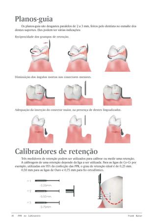 Prótese Parcial Removível Odontológico