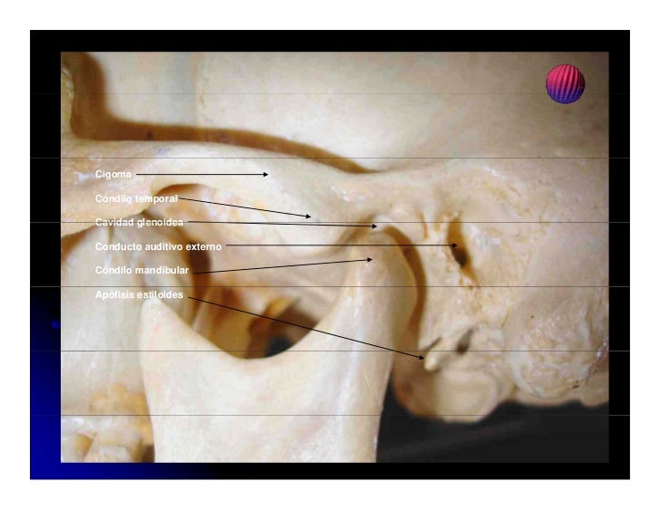 Protesis de condilo mandibular