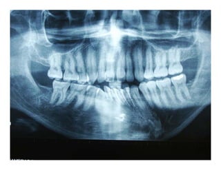 Protesis Inmediata Dental
