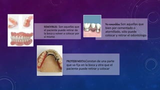 REMOVIBLES: Son aquellas que
el paciente puede retirar de
la boca y volver a colocar por
sí mismo
No removibles:Son aquellas que
bien por cementado o
atornillado, sólo puede
colocar y retirar el odontólogo
PROTESISMIXTA:Constan de una parte
que va fija en la boca y otra que el
paciente puede retirar y colocar
 