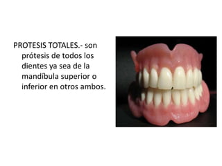 PROTESIS TOTALES.- son
  prótesis de todos los
  dientes ya sea de la
  mandíbula superior o
  inferior en otros ambos.
 