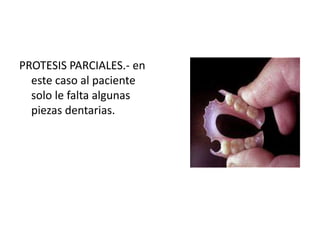 PROTESIS PARCIALES.- en
  este caso al paciente
  solo le falta algunas
  piezas dentarias.
 