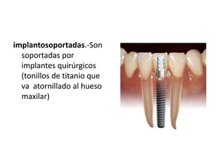 implantosoportadas.-Son
  soportadas por
  implantes quirúrgicos
  (tonillos de titanio que
  va atornillado al hueso
  maxilar)
 