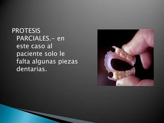 PROTESIS
 PARCIALES.- en
 este caso al
 paciente solo le
 falta algunas piezas
 dentarias.
 