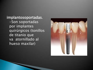 implantosoportadas.
 -Son soportadas
 por implantes
 quirúrgicos (tonillos
 de titanio que
 va atornillado al
 hueso maxilar)
 