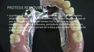 PROTESIS REMOVIBLES
• La prótesis dental (o estomatológica) removible es un tratamiento
dirigido a reemplazar dientes ausentes y las estructuras óseas que se
van atrofiando a lo largo del tiempo tras la pérdida de aquéllos,
mediante unos aparatos bucales, portadores de dientes artificiales,
que se pueden y deben extraer de la boca para facilitar la limpieza de
ésta y de aquéllos.
 