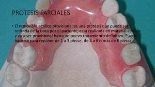 PROTESIS PARCIALES
• El removible acrílico provisional es una prótesis que puede ser
retirada de la boca por el paciente, esta realizada en material acrílico
y va a ser provisional hasta un nuevo tratamiento definitivo. Puede
hacerse para reponer de 1 a 3 piezas, de 4 a 6 o más de 6 piezas.
 