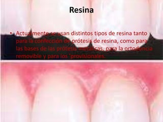 Resina

• Actualmente se usan distintos tipos de resina tanto
  para la confección de prótesis de resina, como para
  las bases de las prótesis metálicas, para la ortodoncia
  removible y para los 'provisionales.
 