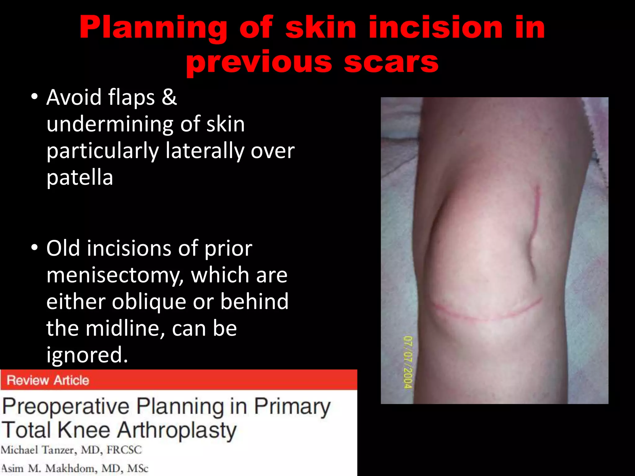 Undermining Incision Protesis de rodilla | PPTX