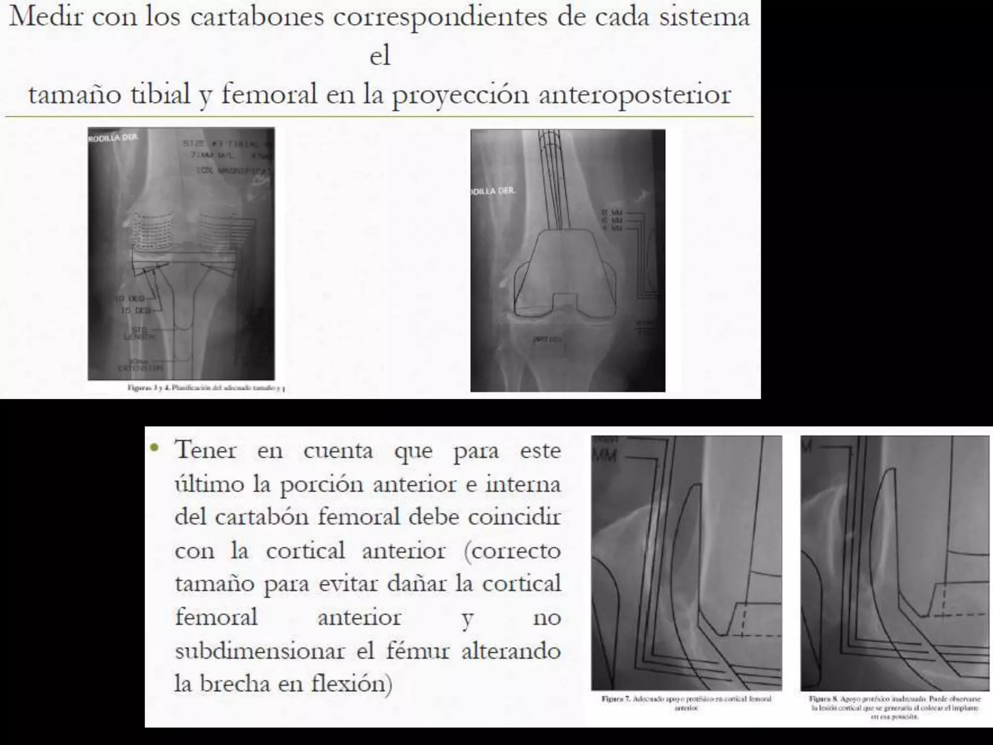 Protesis De Rodilla PPTX
