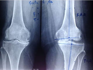 Protesis De Rodilla PPTX