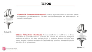 TIPOS
•Prótesis CR (con retención de cruzado): Para su implantación no es necesario retirar
el ligamento cruzado posterior. Ello hace que la biomecánica sea más natural y se
conserva más hueso.
•Prótesis PS (posterior estabilizada): Se usa cuando no es posible o no se desea
conservar el ligamento cruzado posterior. La función del mismo se reemplaza
mediante el uso de un poste que estabiliza la prótesis. Aunque consume más
hueso, muchos cirujanos prefieren la fiabilidad que les ofrece una estabilización
mecánica de la articulación.
 