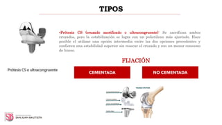 TIPOS
•Prótesis CS (cruzado sacrificado o ultracongruente): Se sacrifican ambos
cruzados, pero la estabilización se logra con un polietileno más ajustado. Hace
posible el utilizar una opción intermedia entre las dos opciones precedentes y
confieren una estabilidad superior sin resecar el cruzado y con un menor consumo
de hueso.
FIJACIÓN
CEMENTADA NO CEMENTADA
 