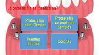La prótesis fija se clasifica en?
Prótesis fija
sobre Dientes
Prótesis fija
con implantes
dentales
Puentes
dentales
Coronas
 