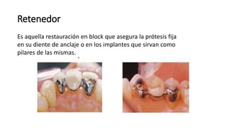 Retenedor 
Es aquella restauración en block que asegura la prótesis fija 
en su diente de anclaje o en los implantes que sirvan como 
pilares de las mismas. 
 
