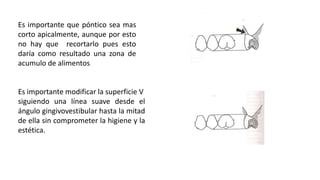 Es importante que póntico sea mas 
corto apicalmente, aunque por esto 
no hay que recortarlo pues esto 
daría como resultado una zona de 
acumulo de alimentos 
Es importante modificar la superficie V 
siguiendo una línea suave desde el 
ángulo gingivovestibular hasta la mitad 
de ella sin comprometer la higiene y la 
estética. 
 