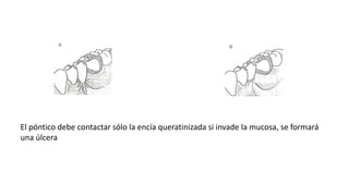 El póntico debe contactar sólo la encía queratinizada si invade la mucosa, se formará 
una úlcera 
 