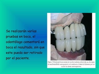 Se realizarán varías pruebas en boca, el odontólogo cementará en  boca el resultado, sin que este pueda ser retirado por el paciente. 