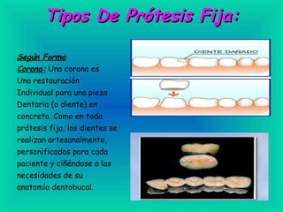 Tipos De Prótesis Fija: Según Forma Corona:  Una corona es Una restauración Individual para una pieza Dentaria (o diente) en concreto. Como en toda prótesis fija, los dientes se realizan artesanalmente, personificados para cada paciente y ciñéndose a las necesidades de su anatomía dentobucal.   